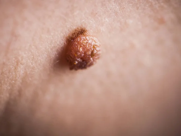 Unrecognizable Person Having Dark Fibroma Dermatology Problem Skin Close Papilloma — Stock Photo, Image