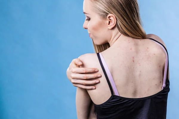 Vrouw met huid probleem acne op de rug — Stockfoto