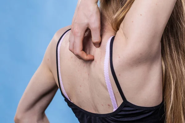 Γυναίκα με δερματικό πρόβλημα ακμής στην πλάτη — Φωτογραφία Αρχείου