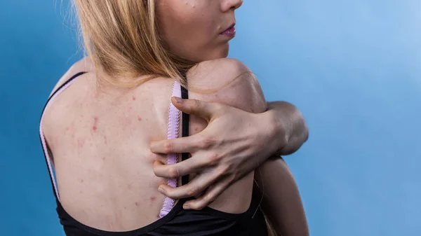 Vrouw met huid probleem acne op de rug — Stockfoto