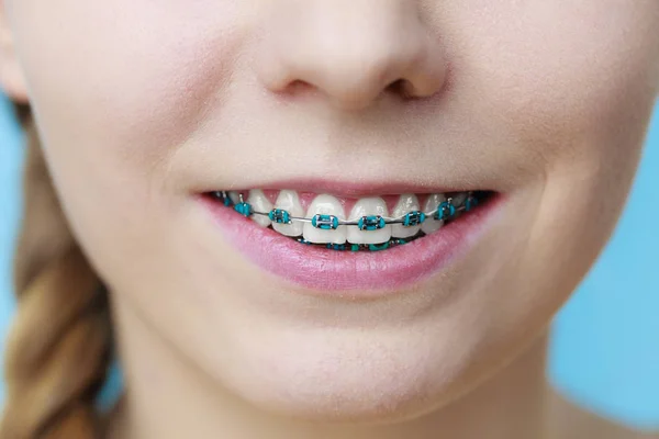 Closeup of woman teeth with braces — Stock Photo, Image