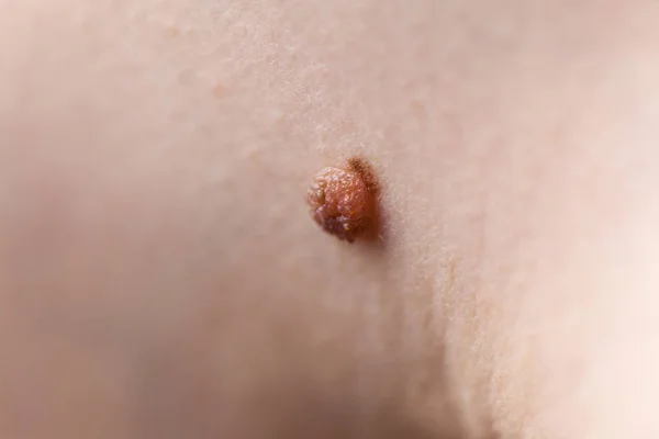 Oigenkännlig Person Med Mörk Fibroma Dermatologi Problem Huden Närbild Papillom — Stockfoto