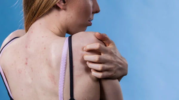 Žena s kožní potížemi na zádech — Stock fotografie