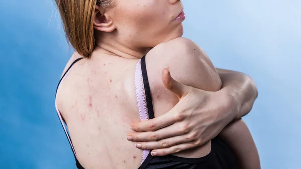 Mujer con problemas de piel acné en la espalda — Foto de Stock