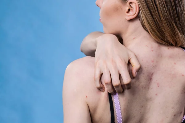 Женщина с кожей акне на спине — стоковое фото