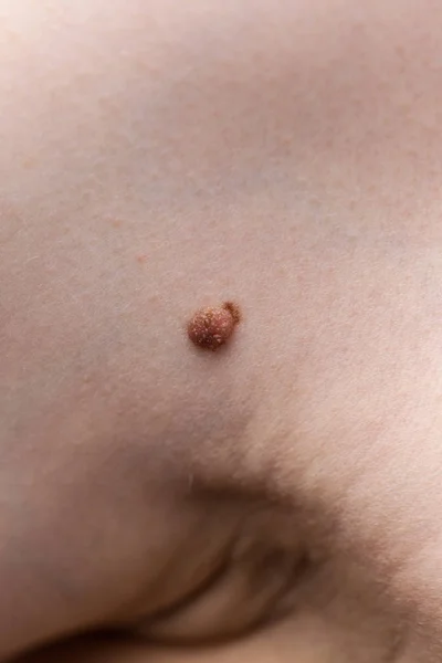 Persona Irreconocible Que Tiene Fibroma Oscuro Problema Dermatológico Piel Primer — Foto de Stock