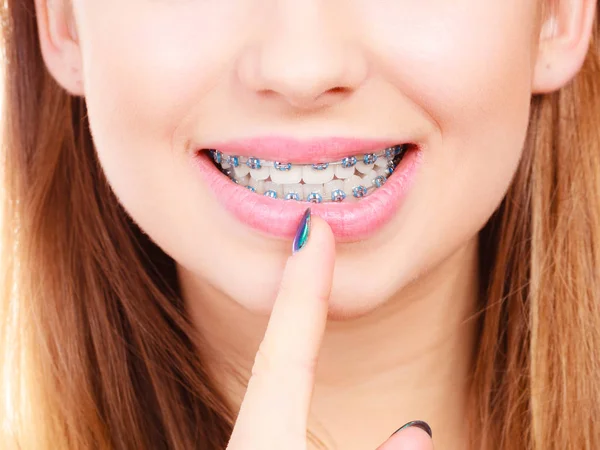 Mujer mostrando sus dientes con aparatos ortopédicos — Foto de Stock