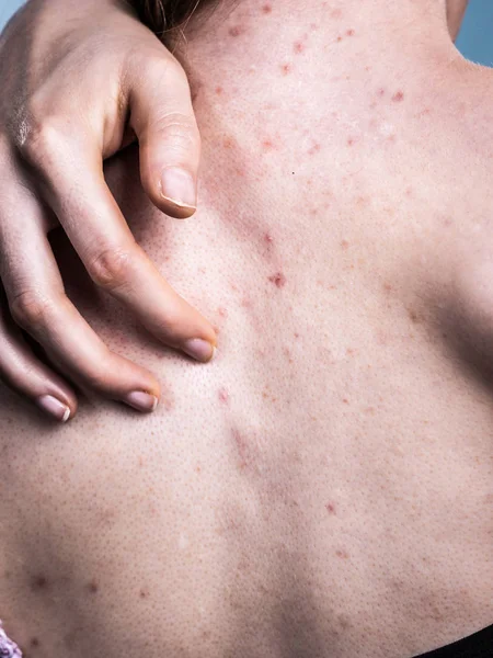 Vrouw met huid probleem acne op de rug — Stockfoto