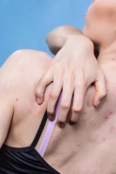 Mujer con problemas de piel acné en la espalda — Foto de Stock
