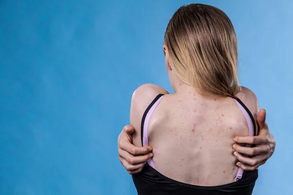 Mujer con problemas de piel acné en la espalda — Foto de Stock