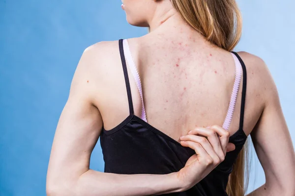 Mujer con problemas de piel acné en la espalda —  Fotos de Stock