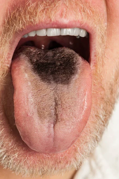 Black hairy tongue closeup