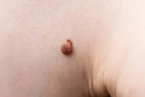 Felismerhetetlen Személy Sötét Fibrómával Bőrgyógyászati Problémákkal Bőrén Papilloma Dermatosis Közeli — Stock Fotó