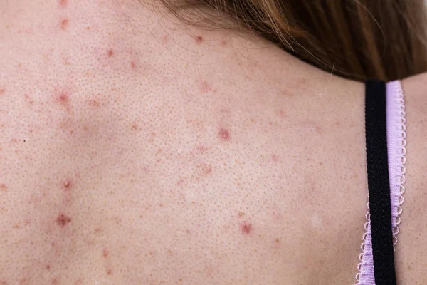 Vrouw met huid probleem acne op de rug — Stockfoto