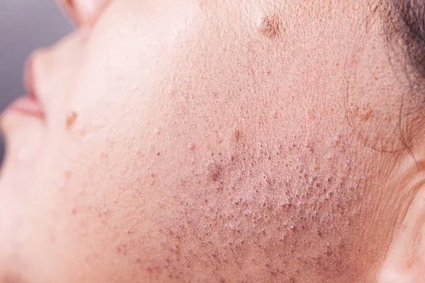 Πρόσωπο δέρματος μετά την αφαίρεση των μαλλιών — Φωτογραφία Αρχείου