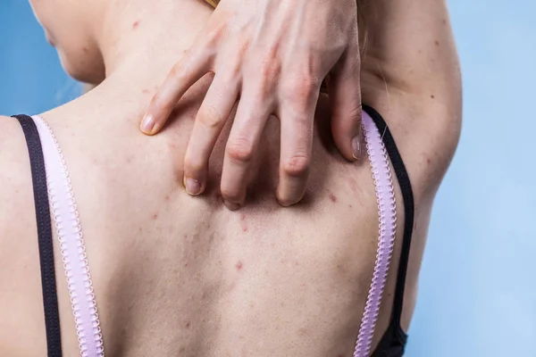 背面に皮膚の問題のにきびを持つ女性 — ストック写真