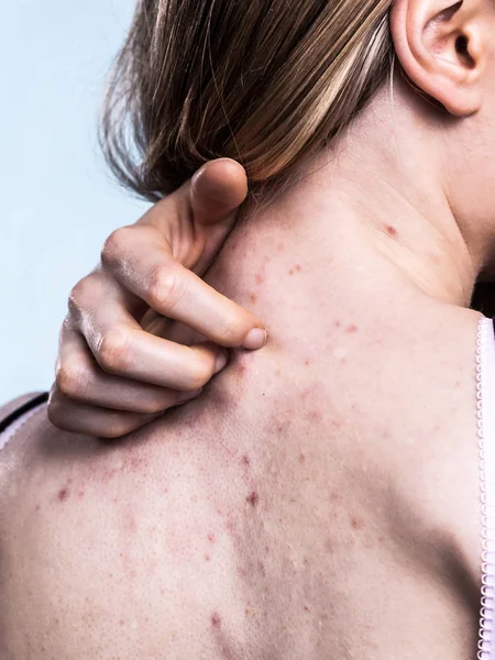 Vrouw met huid probleem acne op de rug — Stockfoto