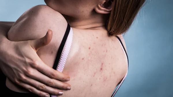 Vrouw met huid probleem acne op de rug — Stockfoto