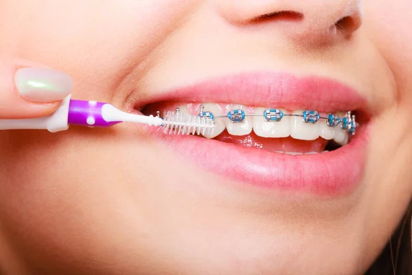 Woman brushing teeth with braces using brush — Stock Photo, Image