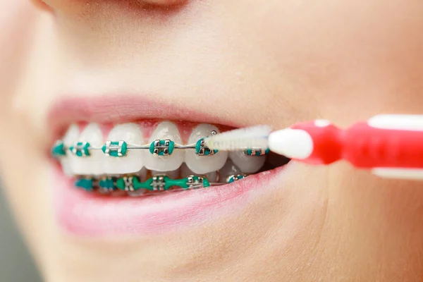 Zubař Ortodontista Mladá Žena Modrými Rovnátky Čištění Čištění Zubů Pomocí — Stock fotografie