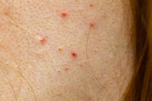 Feche Pele Com Toupeiras Acne Lugares Vermelhos Problema Saúde Doenças — Fotografia de Stock