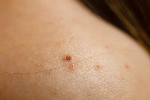 Nahaufnahme Der Haut Mit Akne Muttermalen Und Roten Flecken Gesundheitsproblem — Stockfoto
