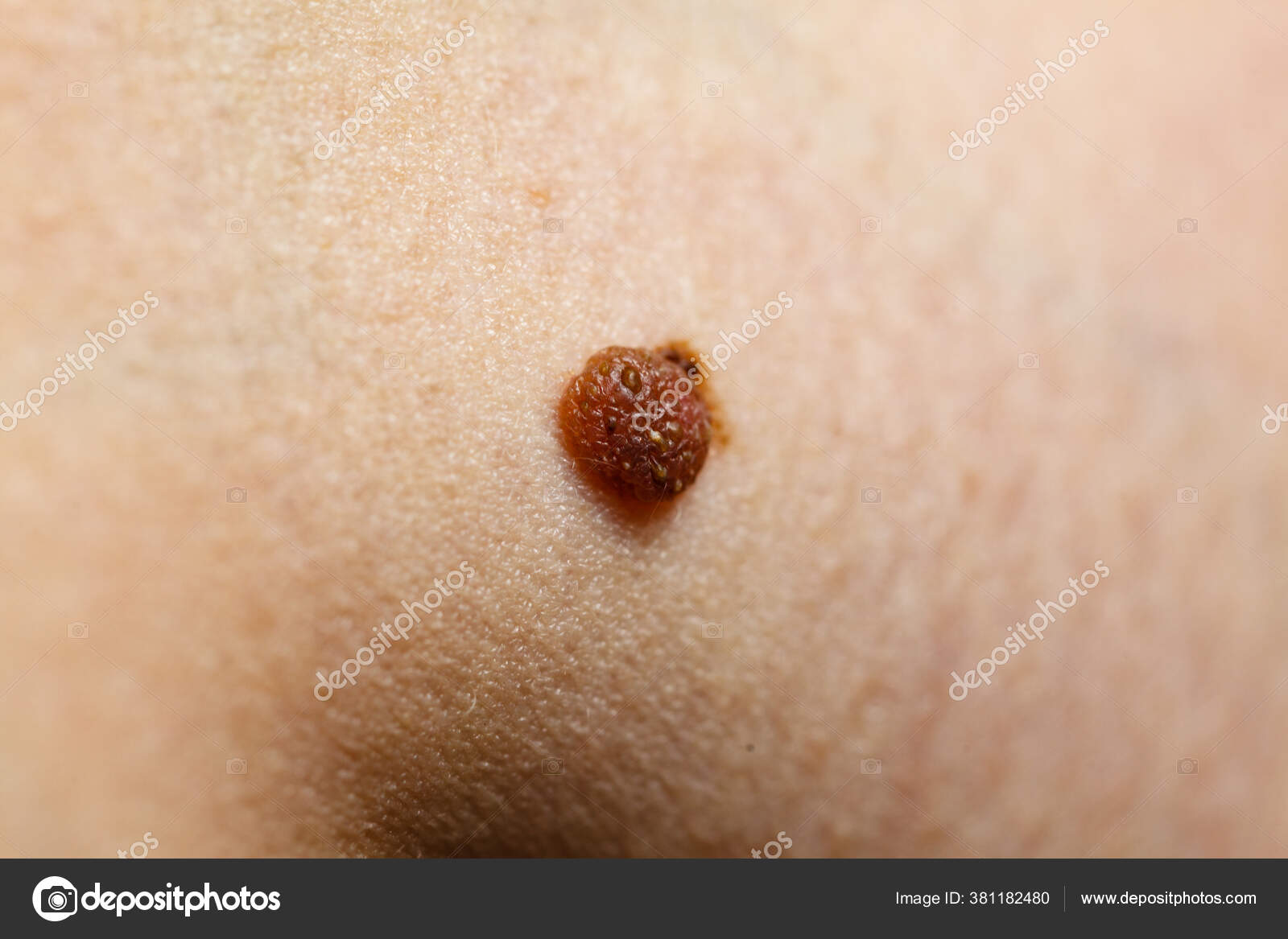 Болезнь Кожи Крупный План Коричневого Крота Кавказском.