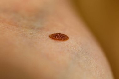 Skin disease. Closeup brown mole on caucasian human body. clipart