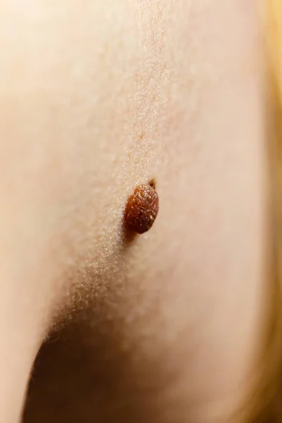 Skin Disease Closeup Brown Mole Caucasian Human Body — Stock Photo, Image