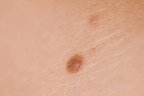 Skin Disease Closeup Brown Mole Caucasian Human Body — Stock Photo, Image