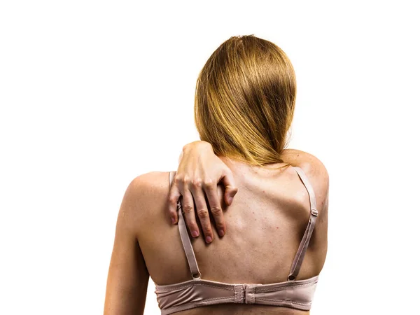 Health Problem Skin Diseases Young Woman Showing Her Back Acne — Stock Photo, Image