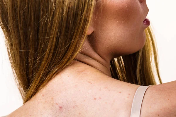 Egészségügyi Problémák Bőrbetegségek Egy Fiatal Aki Pattanásos Piros Foltokkal Mutatja — Stock Fotó
