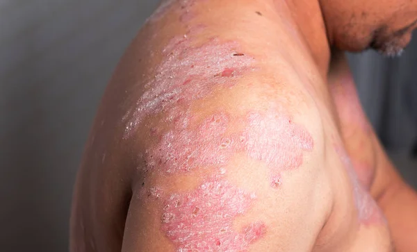 リンパ節や皮膚病の異常によって引き起こされる病気 — ストック写真
