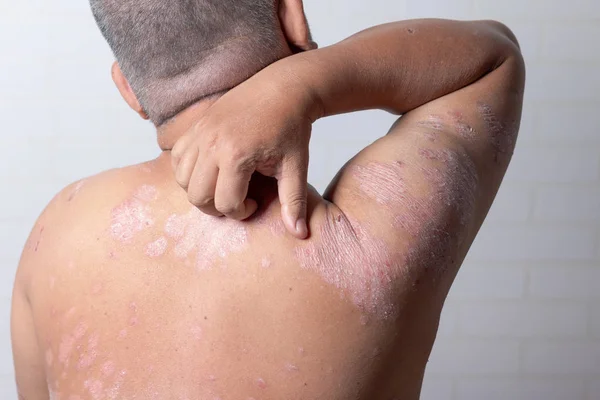 Les Hommes Servent Ses Mains Pour Gratter Les Ulcères Épaule — Photo