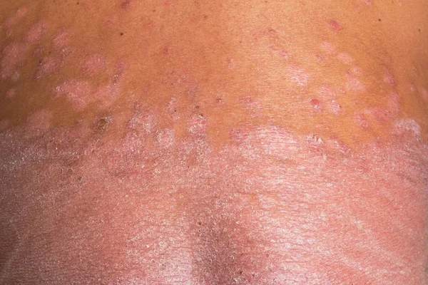 The back is full of psoriasis. Diseases caused by abnormalities of the lymph and a skin disease.