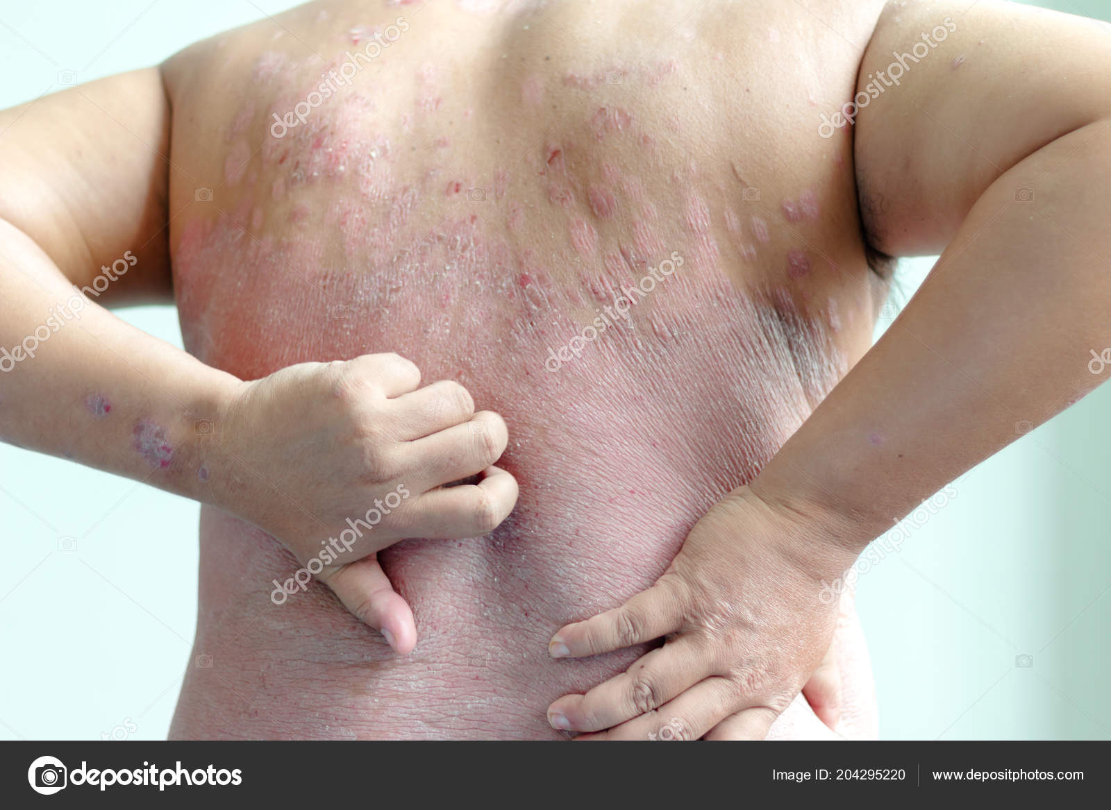 Pacientes Estão Coçar Próprias Costas Cheios Feridas Doenças Causadas Por —  Foto © Nikkikii #204295220, image size:1600x1167