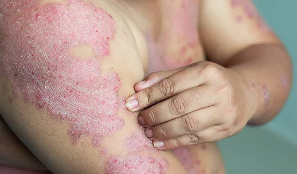 Muži Rukama Škrábou Ránu Pažích Nemoci Způsobené Abnormalitami Lymfy Psoriáza — Stock fotografie