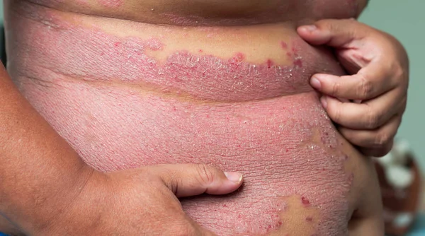 Muži Drží Břicho Škrábání Ránu Nemoci Způsobené Abnormality Lymfy Psoriáza — Stock fotografie