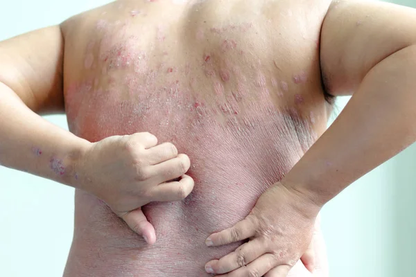病人们都在抓着自己的背部 充满了伤痕 由淋巴异常引起的疾病 银屑病是一种皮肤病 选择焦点浅景深和模糊背景 — 图库照片