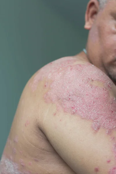 Patients look at their own shoulder filled with inflammation. Diseases caused by abnormalities of the lymph. Psoriasis is a skin disease. Select focus shallow depth of field and blurred background