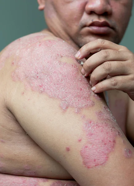 People Psoriasis Look Arms Full Wounds Scratches Diseases Caused Abnormalities — Stock Photo, Image