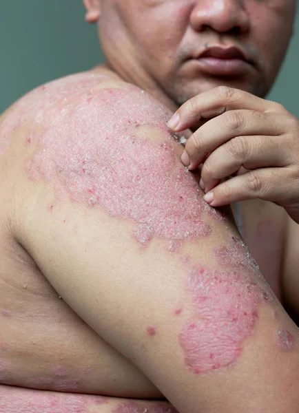 Pessoas Com Psoríase Olham Para Braços Cheios Feridas Arranhões Doenças — Fotografia de Stock