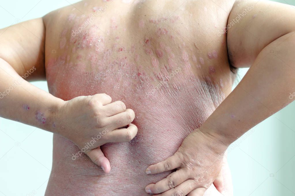 Patients are scratching their own back, full of wounds. Diseases caused by abnormalities of the lymph. Psoriasis is a skin disease. Select focus shallow depth of field and blurred background
