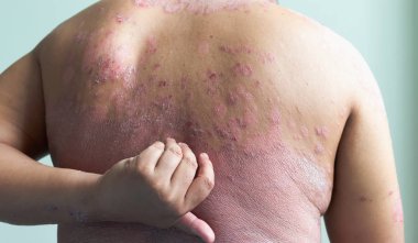 Hastalar kendilerini inflamatuar lezyonlar dolu tırmalamak kendi elleriyle kullanıyorsunuz. Lenf anormallikler tarafından neden olduğu hastalıklar. Sedef bir deri hastalığıdır. Odak alan sığ derinliği seçin.