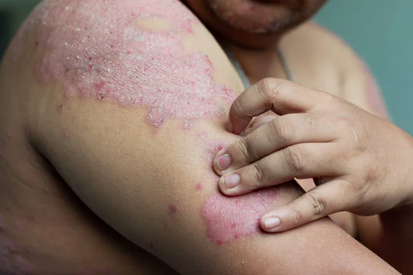 Mężczyźni Drapią Się Rękami Ranie Ramionach Choroby Spowodowane Nieprawidłowościami Limfy — Zdjęcie stockowe