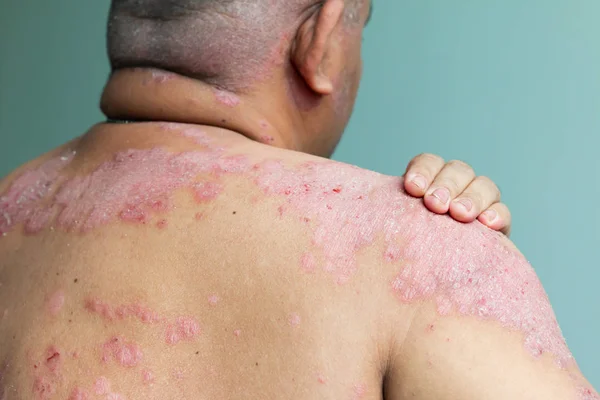 Pacient Drží Rameno Zranění Nemoci Způsobené Abnormality Lymfy Psoriáza Kožní — Stock fotografie