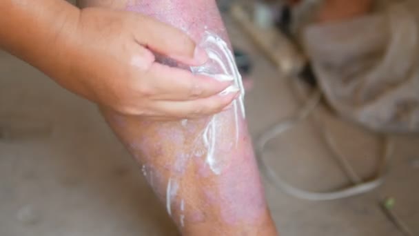 Psoriasis Patiënten Gebruik Van Kruidengeneesmiddelen Gebruiken Hun Eigen Benen Met — Stockvideo