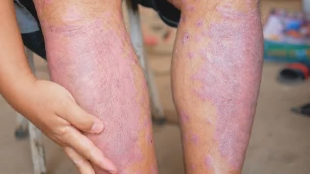 银屑病患者使用草药用自己的腿有伤口 淋巴异常和皮肤病引起的疾病 — 图库视频影像