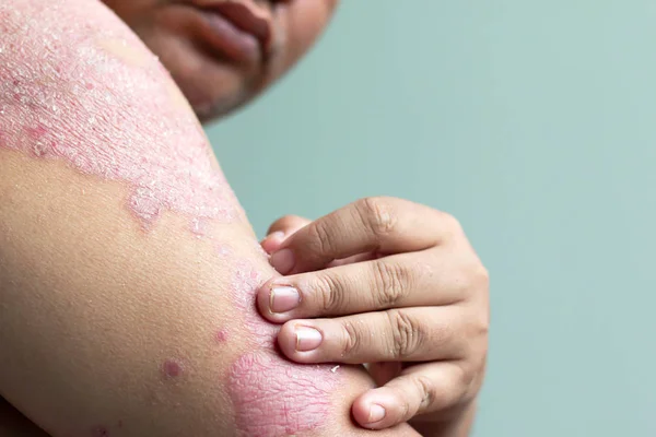 El enfermo de psoriasis mira su brazo lleno de heridas — Foto de Stock