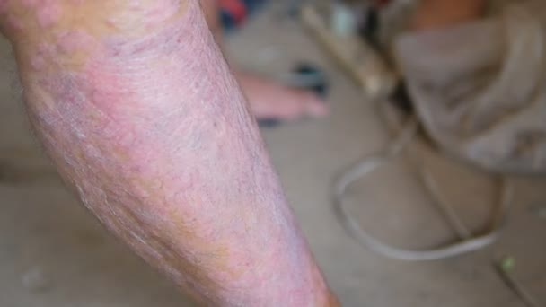 乾癬患者は 傷と自分の足を使用するのに漢方薬を使用します リンパ節や皮膚の異常によって引き起こされる病気 — ストック動画